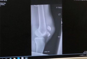 ratigans office broken bone